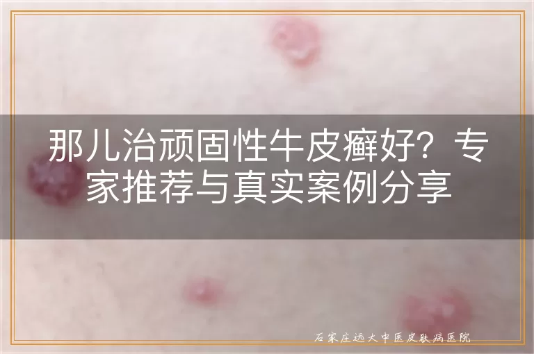 那儿治顽固性牛皮癣好？专家推荐与真实案例分享