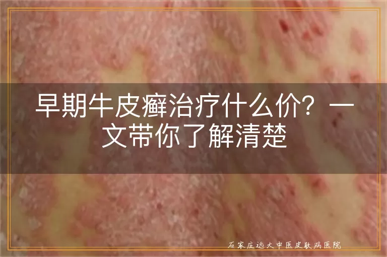 早期牛皮癣治疗什么价？一文带你了解清楚