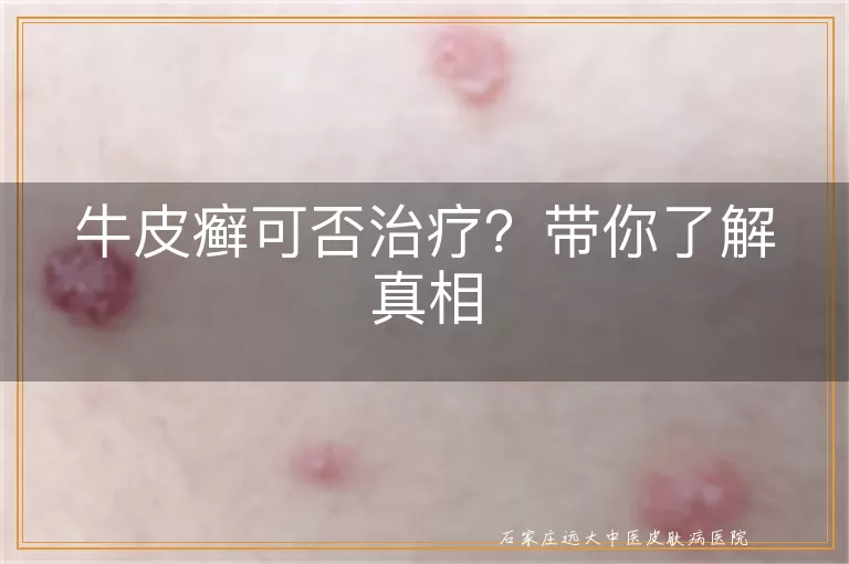 牛皮癣可否治疗？带你了解真相