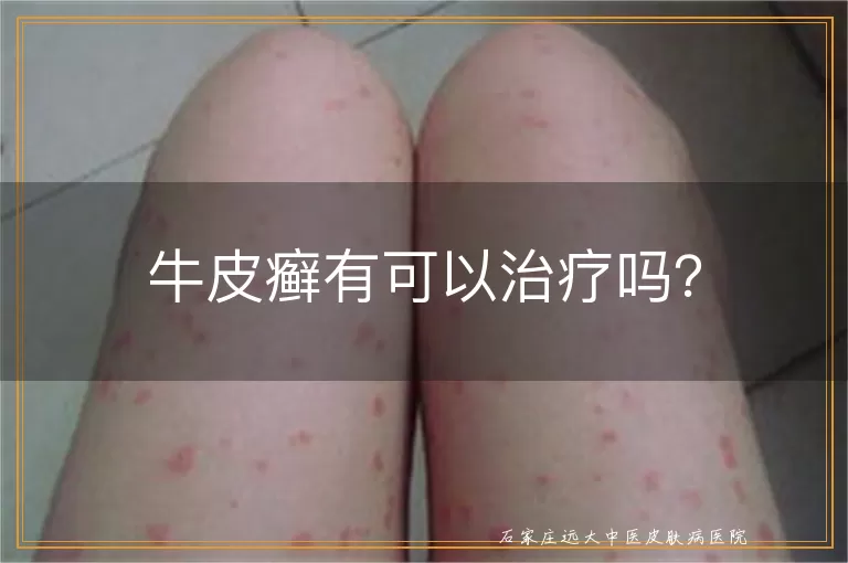 牛皮癣有可以治疗吗？