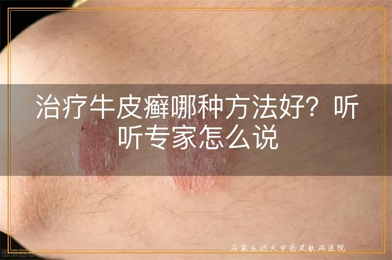 治疗牛皮癣哪种方法好？听听专家怎么说