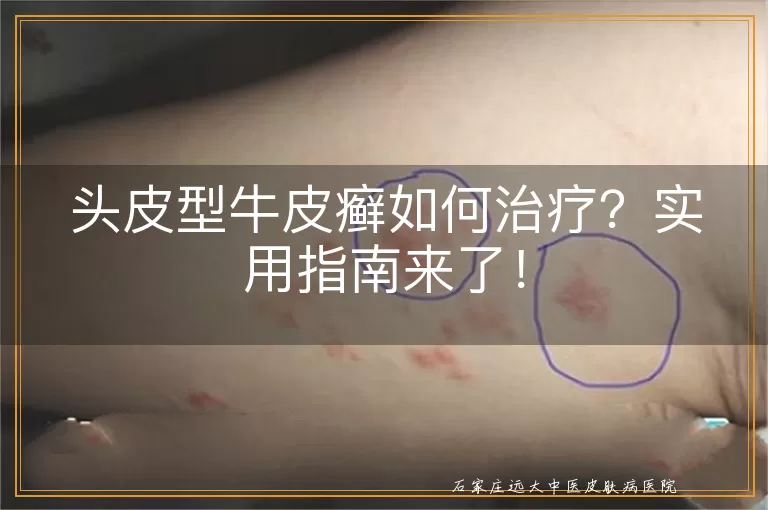 头皮型牛皮癣如何治疗？实用指南来了！