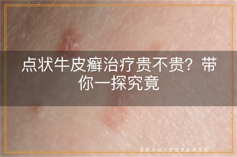 点状牛皮癣治疗贵不贵？带你一探究竟