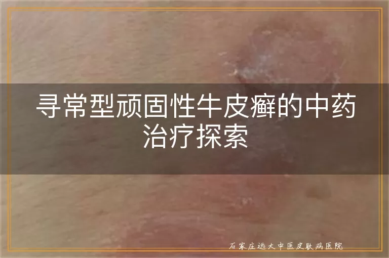 寻常型顽固性牛皮癣的中药治疗探索