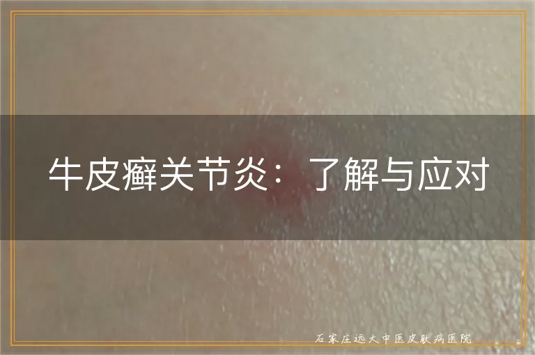 牛皮癣关节炎：了解与应对