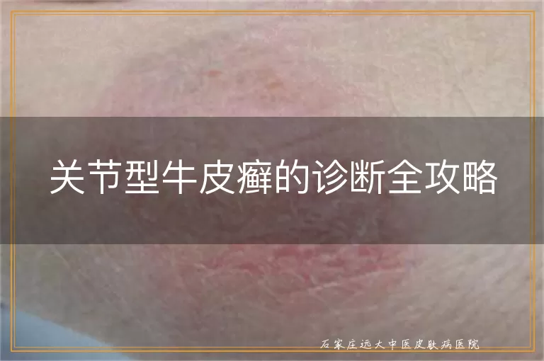 关节型牛皮癣的诊断全攻略