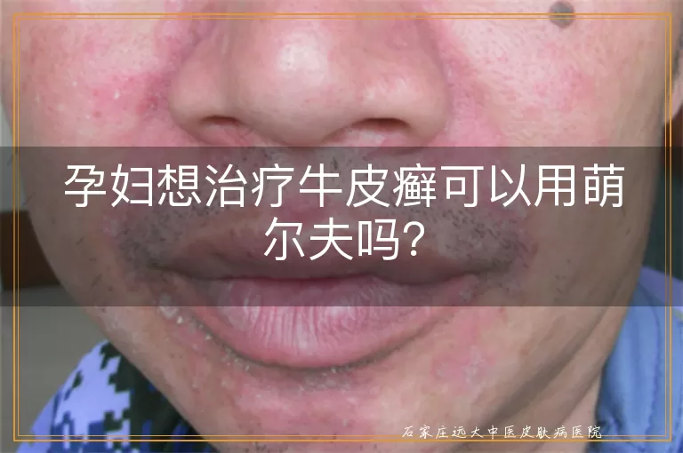 孕妇想治疗牛皮癣可以用萌尔夫吗？