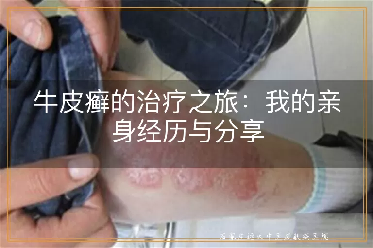 牛皮癣的治疗之旅：我的亲身经历与分享