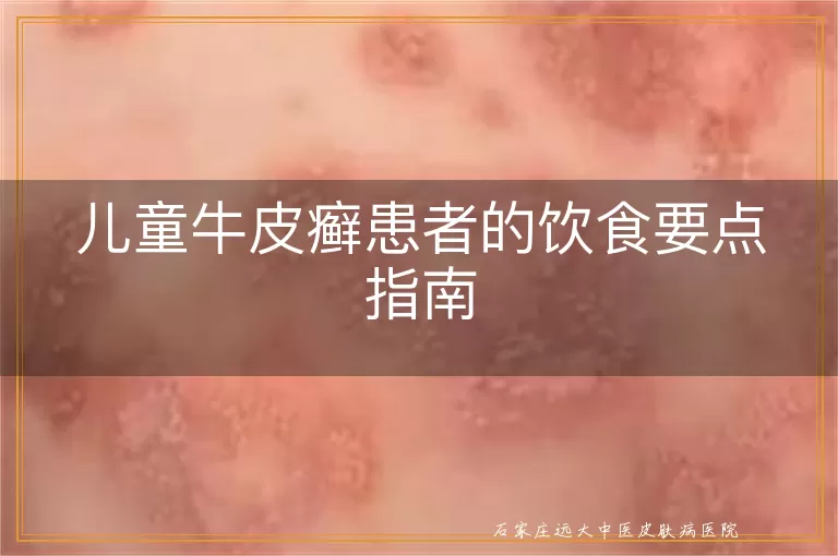 儿童牛皮癣患者的饮食要点指南