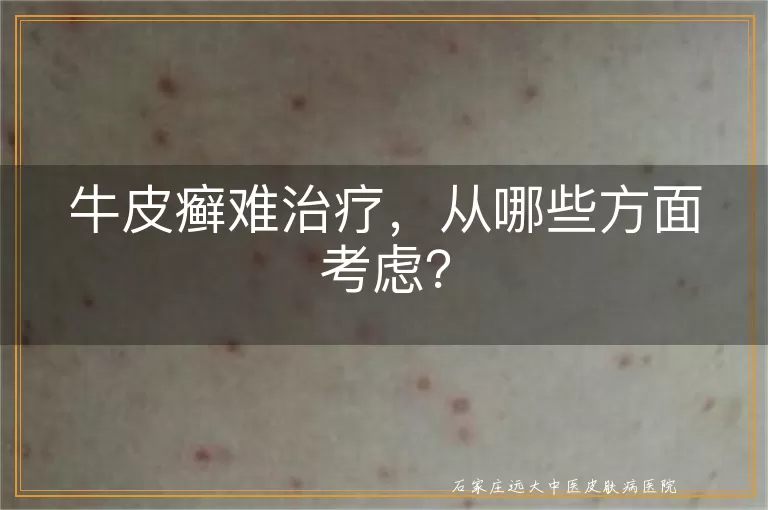 牛皮癣难治疗，从哪些方面考虑？