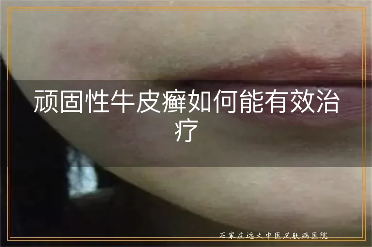 顽固性牛皮癣如何能有效治疗