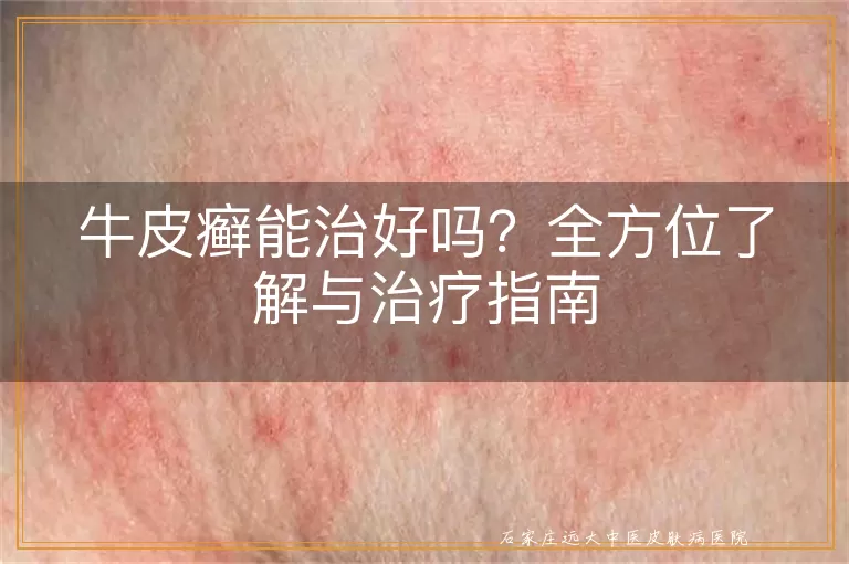 牛皮癣能治好吗？全方位了解与治疗指南