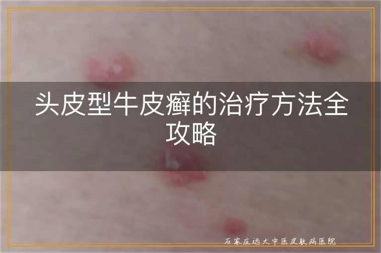 头皮型牛皮癣的治疗方法全攻略