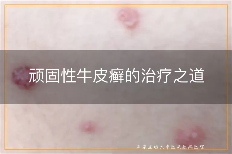 顽固性牛皮癣的治疗之道