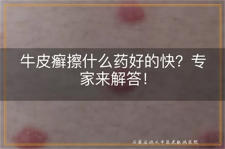 牛皮癣擦什么药好的快？专家来解答！