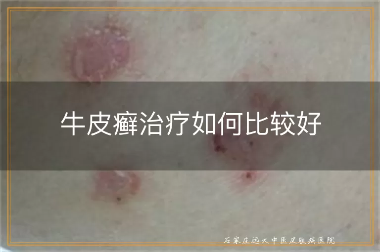 牛皮癣治疗如何比较好