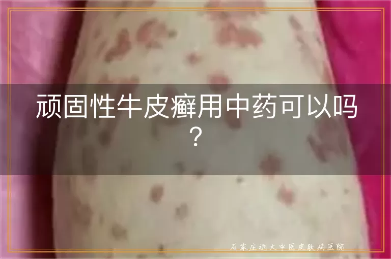 顽固性牛皮癣用中药可以吗？