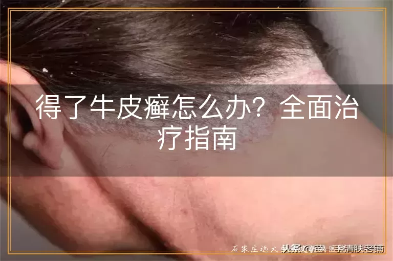 得了牛皮癣怎么办？全面治疗指南