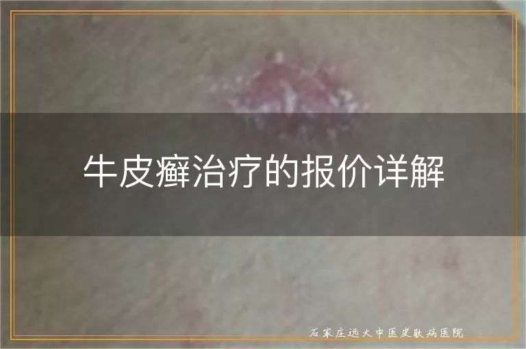 牛皮癣治疗的报价详解