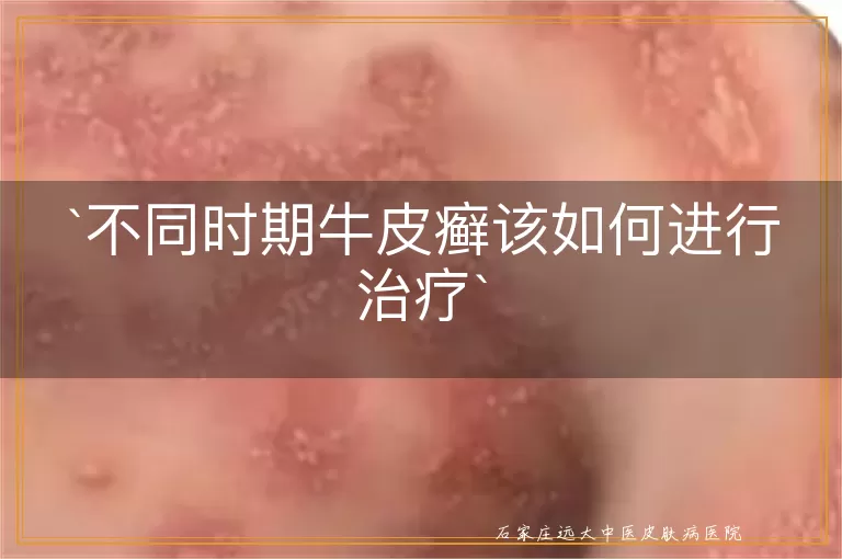 不同时期牛皮癣该如何进行治疗