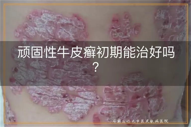 顽固性牛皮癣初期能治好吗？