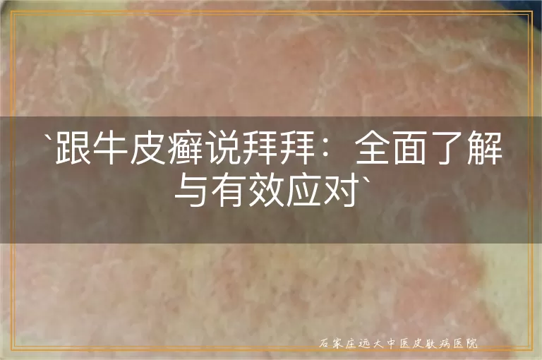 跟牛皮癣说拜拜：全面了解与有效应对