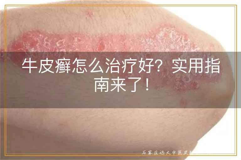 牛皮癣怎么治疗好？实用指南来了！