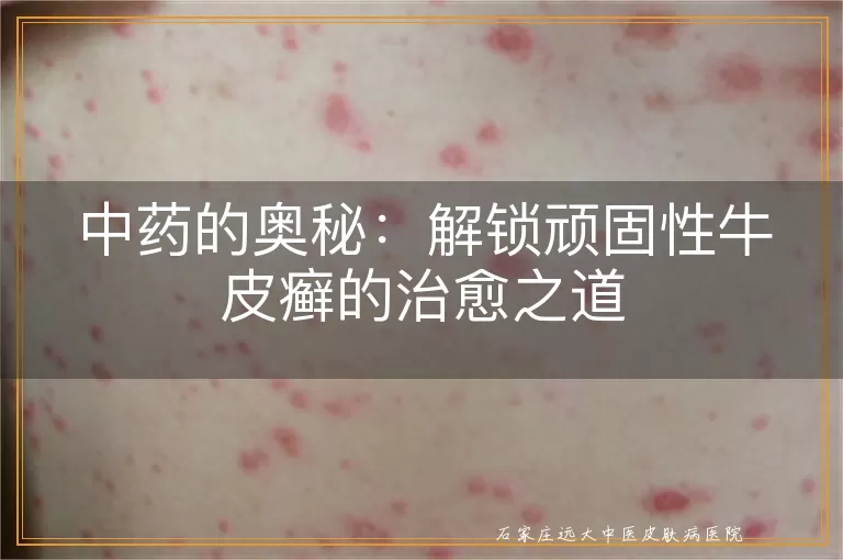 中药的奥秘：解锁顽固性牛皮癣的治愈之道