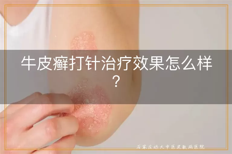 牛皮癣打针治疗效果怎么样？