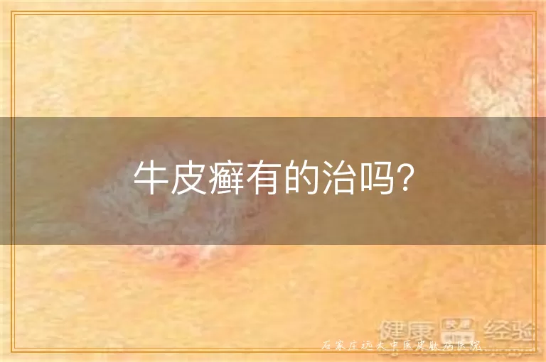 牛皮癣有的治吗？