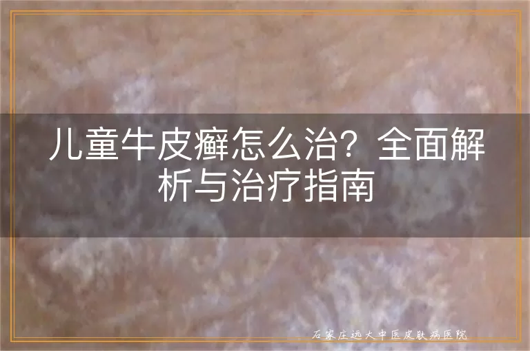 儿童牛皮癣怎么治？全面解析与治疗指南