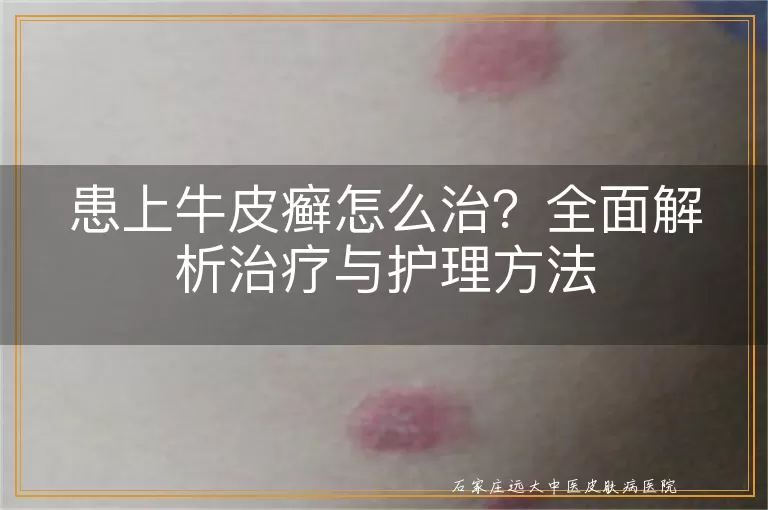 患上牛皮癣怎么治？全面解析治疗与护理方法