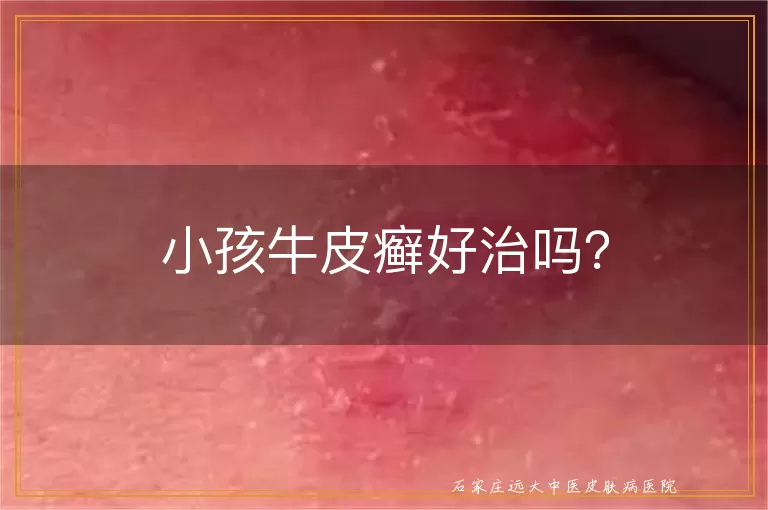 小孩牛皮癣好治吗？