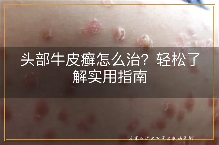 头部牛皮癣怎么治？轻松了解实用指南