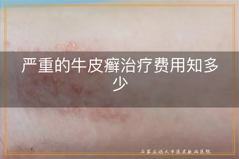 严重的牛皮癣治疗费用知多少