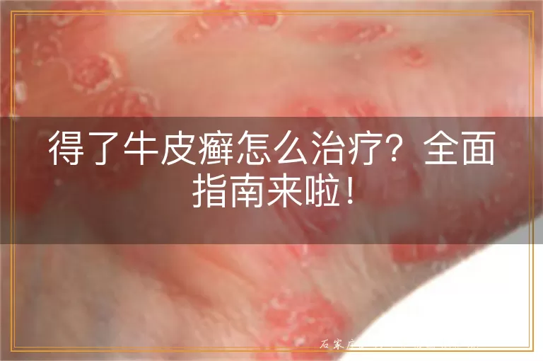 得了牛皮癣怎么治疗？全面指南来啦！