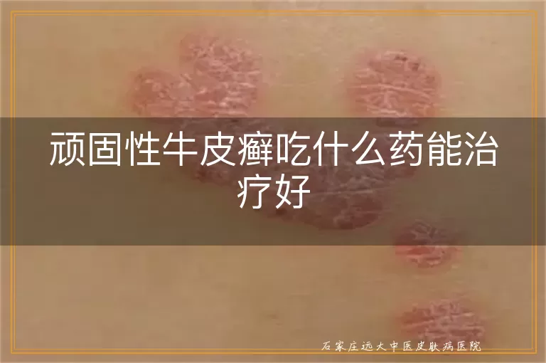 顽固性牛皮癣吃什么药能治疗好