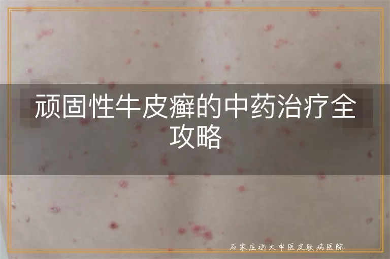 顽固性牛皮癣的中药治疗全攻略