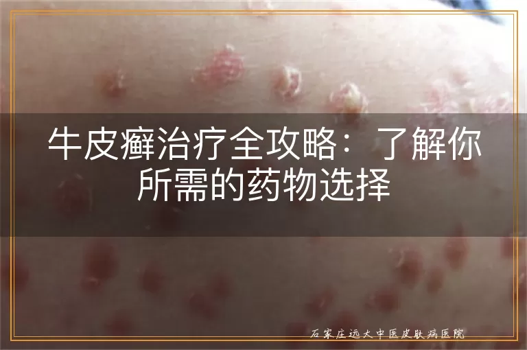 牛皮癣治疗全攻略：了解你所需的药物选择