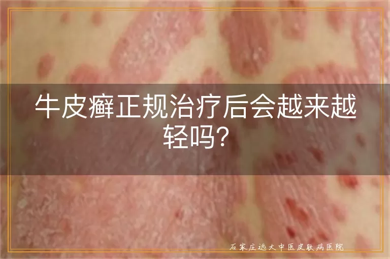 牛皮癣正规治疗后会越来越轻吗？