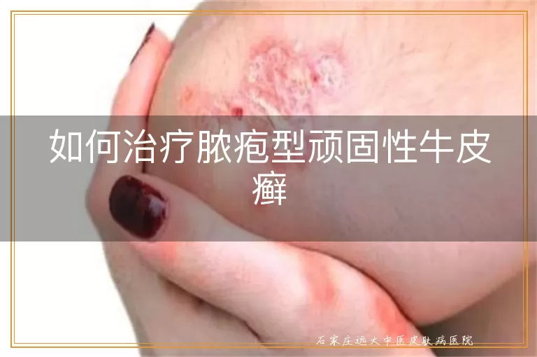 如何治疗脓疱型顽固性牛皮癣