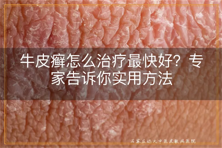 牛皮癣怎么治疗最快好？专家告诉你实用方法