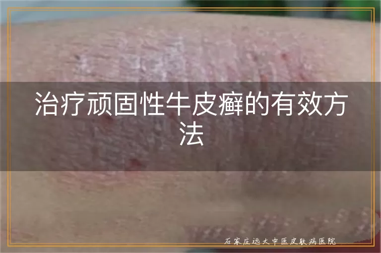 治疗顽固性牛皮癣的有效方法