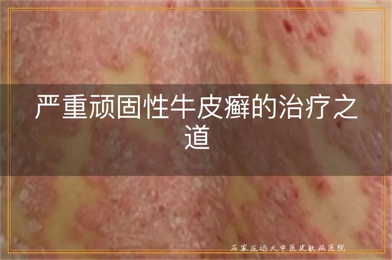 严重顽固性牛皮癣的治疗之道