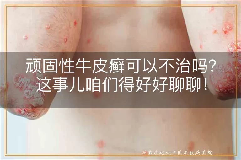 顽固性牛皮癣可以不治吗？这事儿咱们得好好聊聊！