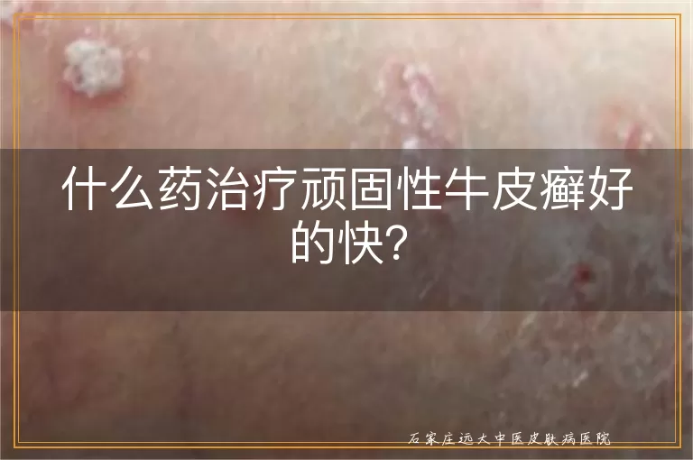 什么药治疗顽固性牛皮癣好的快？