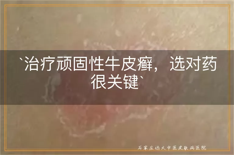 治疗顽固性牛皮癣，选对药很关键