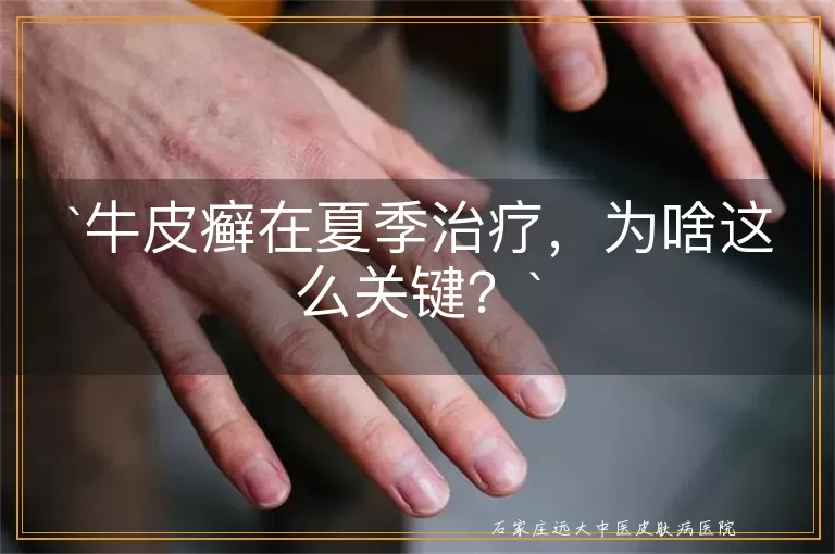 牛皮癣在夏季治疗，为啥这么关键？