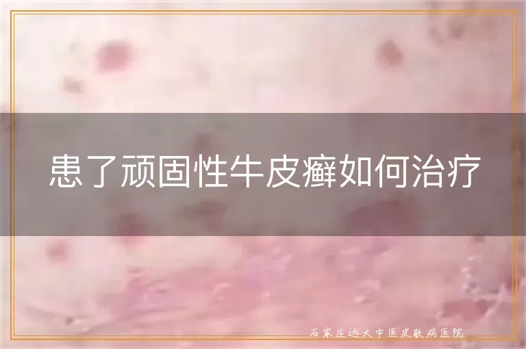 患了顽固性牛皮癣如何治疗