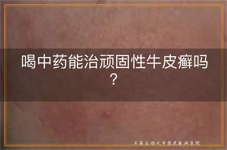 喝中药能治顽固性牛皮癣吗？